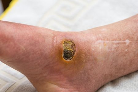 Abses dan Ulkus Diabetik